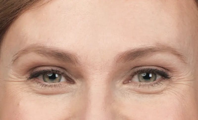 BOTOX® Cosmetic Before & After Gallery - Patient 180972 - Image 1