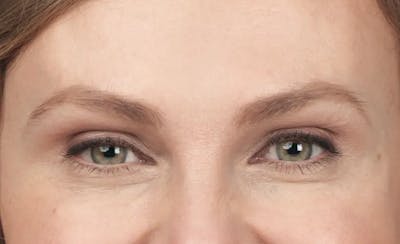 BOTOX® Cosmetic Before & After Gallery - Patient 180972 - Image 2