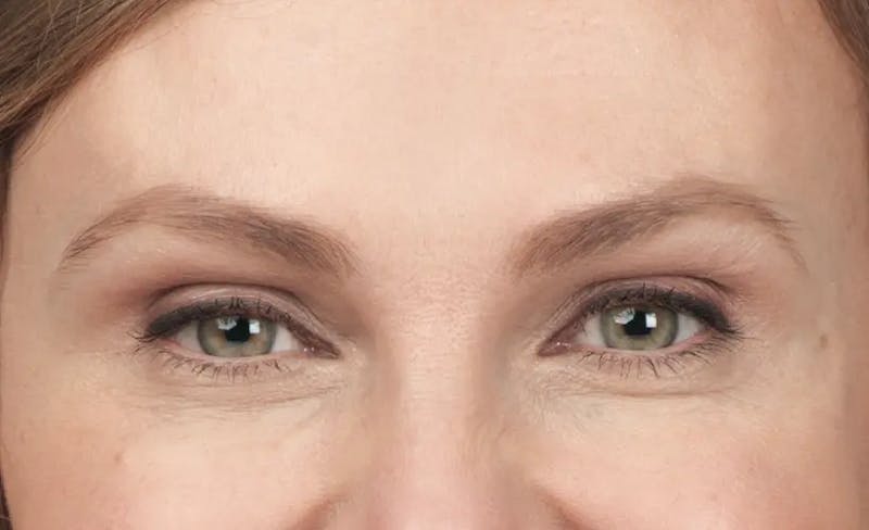 BOTOX® Cosmetic Before & After Gallery - Patient 180972 - Image 2