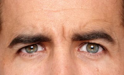 BOTOX® Cosmetic Before & After Gallery - Patient 142249 - Image 1