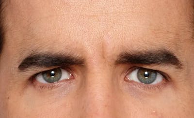 BOTOX® Cosmetic Before & After Gallery - Patient 142249 - Image 2