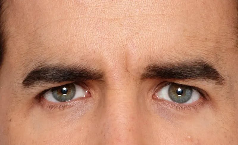 BOTOX® Cosmetic Before & After Gallery - Patient 142249 - Image 2