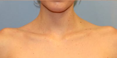 Traptox Trapezius Botox Before & After Gallery - Patient 204707 - Image 2
