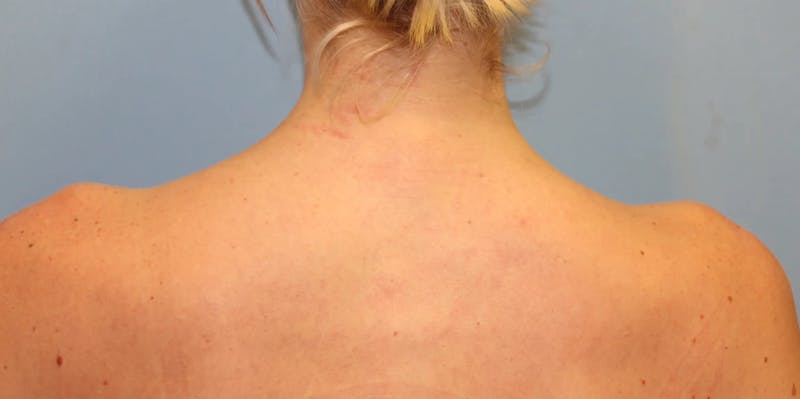 Traptox Trapezius Botox Before & After Gallery - Patient 204707 - Image 4