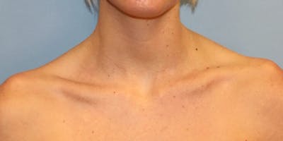 Traptox Trapezius Botox Before & After Gallery - Patient 204707 - Image 1