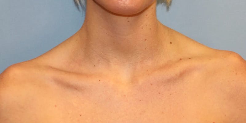 Traptox Trapezius Botox Before & After Gallery - Patient 204707 - Image 1