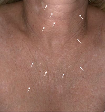 SylfirmX Microneedling Before & After Gallery - Patient 107901 - Image 1