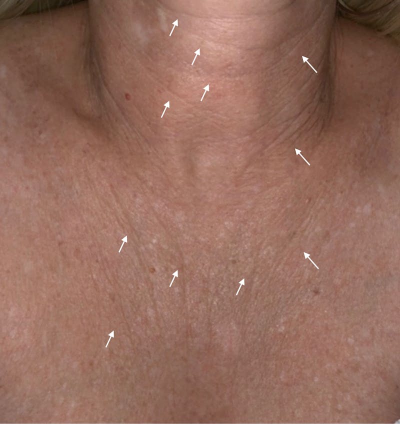 SylfirmX Microneedling Before & After Gallery - Patient 107901 - Image 1