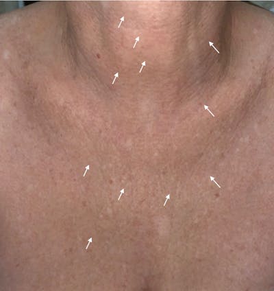 SylfirmX Microneedling Before & After Gallery - Patient 107901 - Image 2