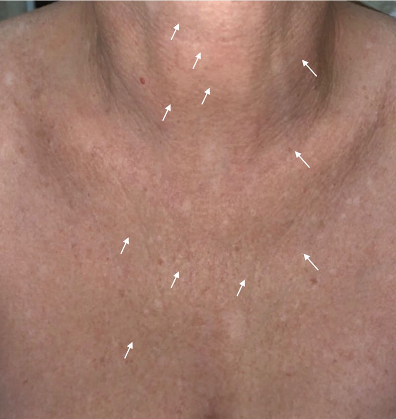 SylfirmX Microneedling Before & After Gallery - Patient 107901 - Image 2