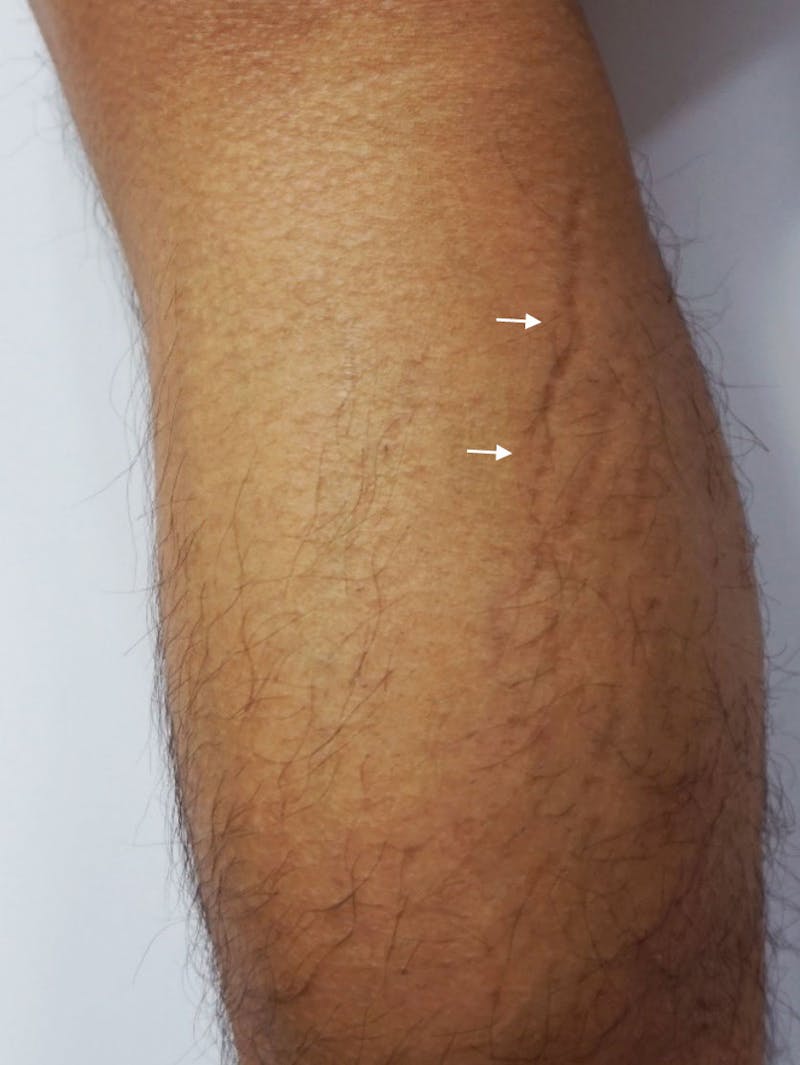 SylfirmX Microneedling Before & After Gallery - Patient 332834 - Image 1