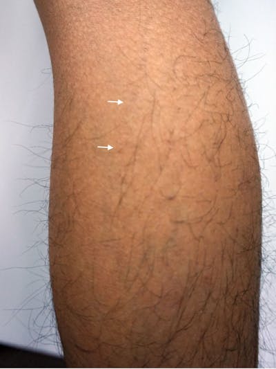 SylfirmX Microneedling Before & After Gallery - Patient 332834 - Image 2