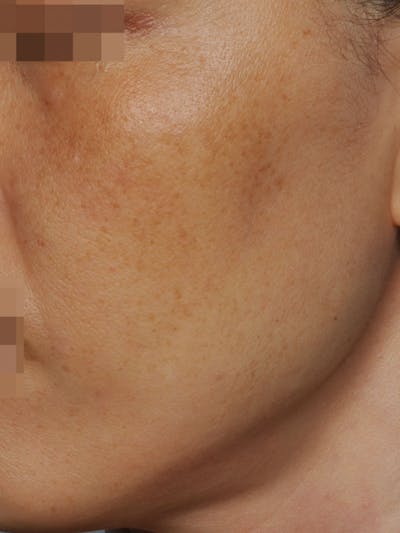 SylfirmX Microneedling Before & After Gallery - Patient 861325 - Image 1