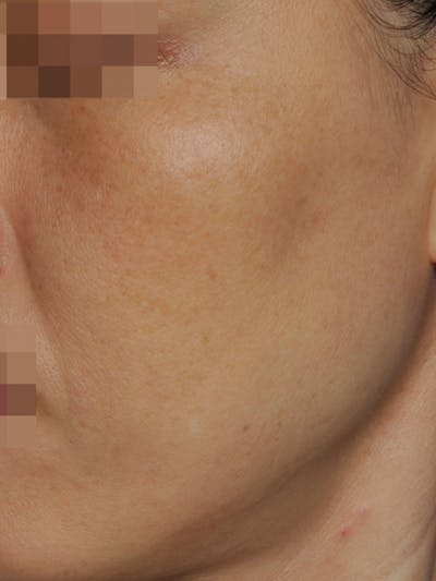 SylfirmX Microneedling Before & After Gallery - Patient 861325 - Image 2