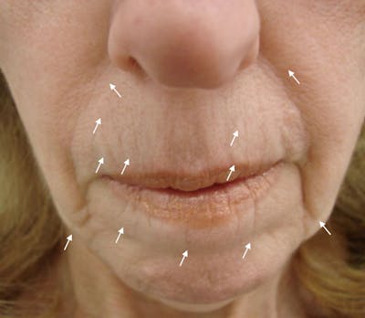 SylfirmX Microneedling Before & After Gallery - Patient 368016 - Image 1