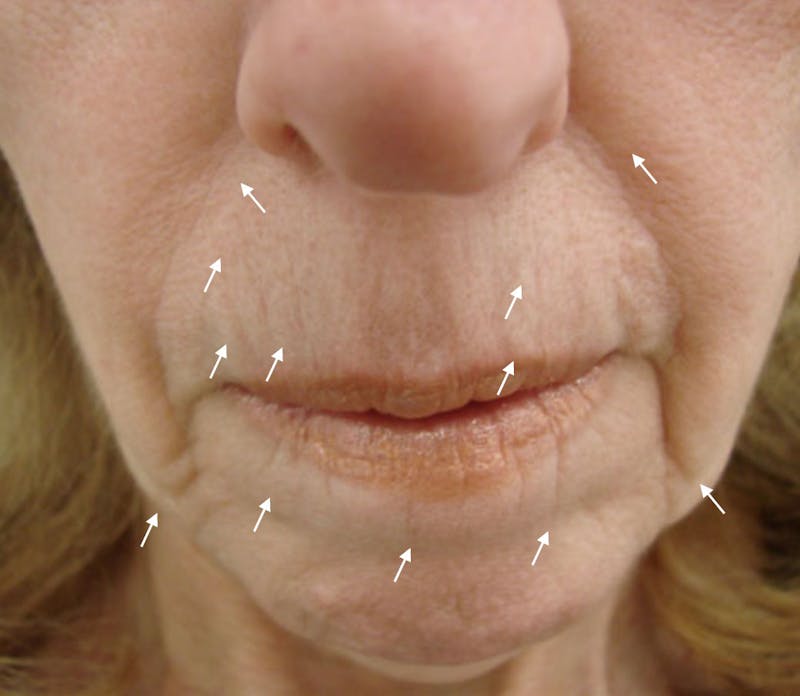 SylfirmX Microneedling Before & After Gallery - Patient 368016 - Image 1