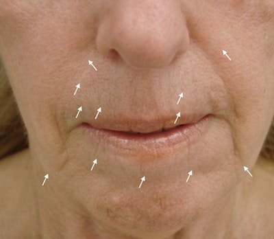 SylfirmX Microneedling Before & After Gallery - Patient 368016 - Image 2
