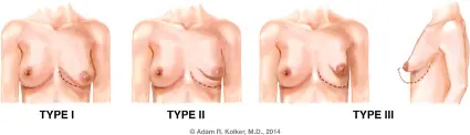 tuberous breast inforgraphic