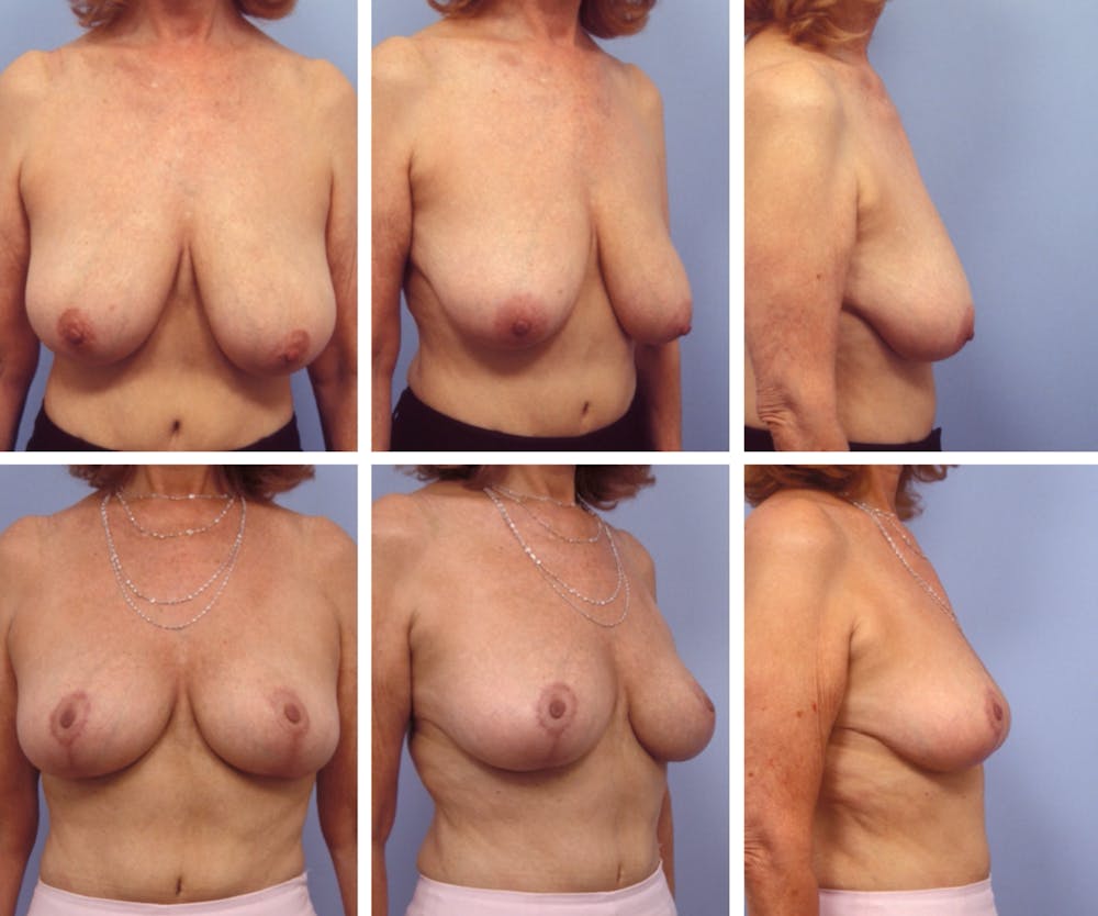 breast lift - los angeles