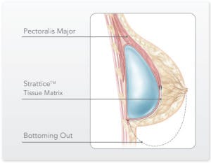 Bottoming-out