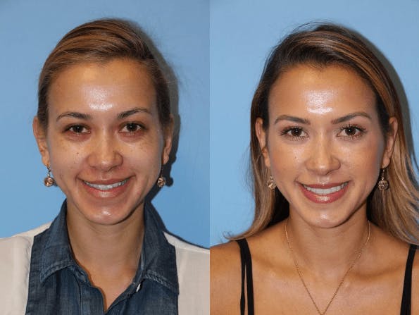 Restylane under the eyes - Dr Jimmy Firouz