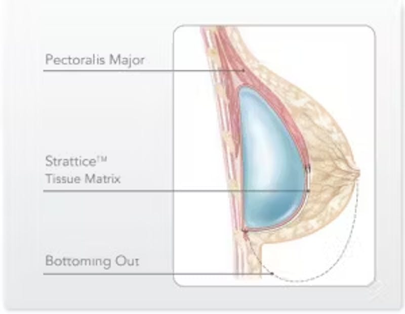 Bottoming Out Graphic