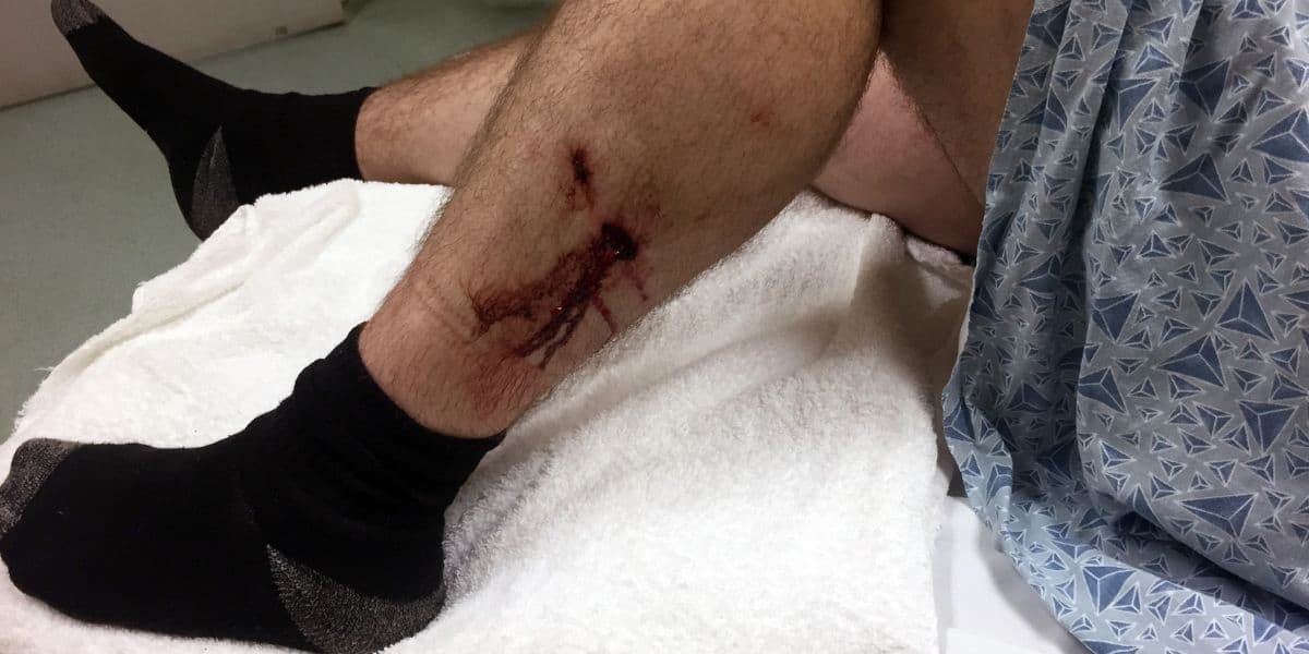 dog bite male leg