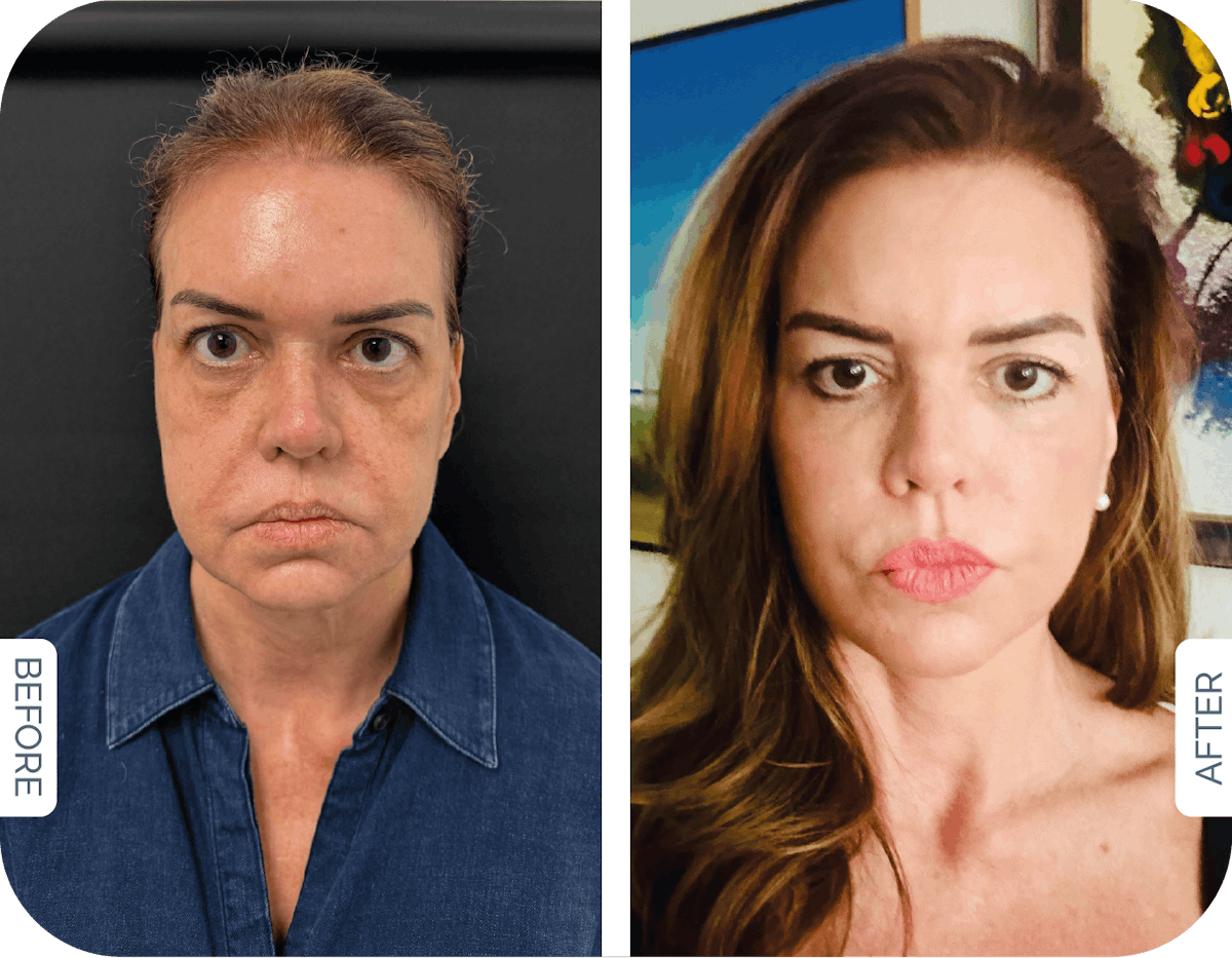 Buccal Fat Pad Removal Before & After Gallery - Patient 859156 - Image 1