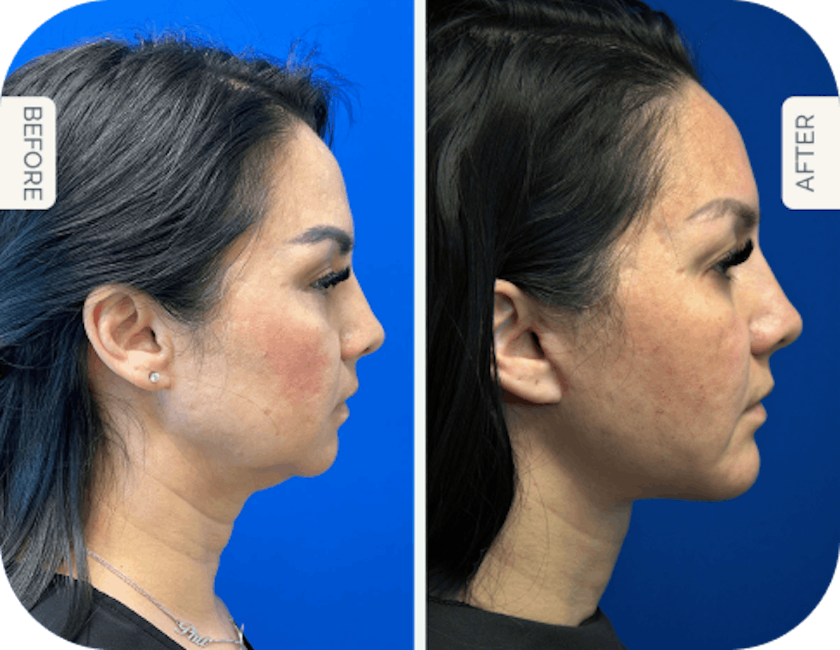 Miami Facelift/Neck Lift Before & After Gallery - Patient 200442 - Image 1 - The Chopra Plastic Surgery Center