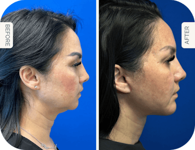 Miami Facelift/Neck Lift Before & After Gallery - Patient 200442 - Image 1 - The Chopra Plastic Surgery Center