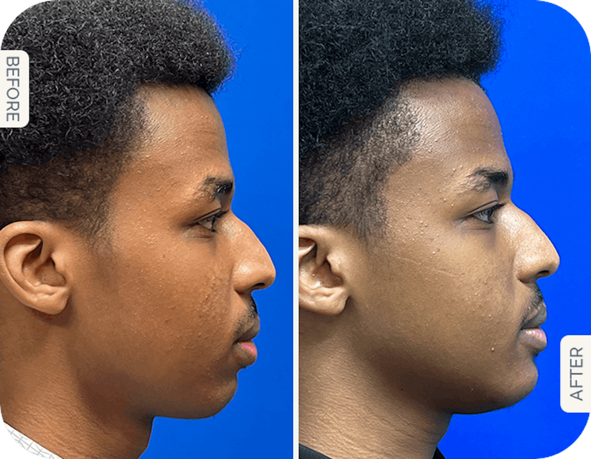 Chin Augmentation Before & After Gallery - Patient 335822 - Image 1