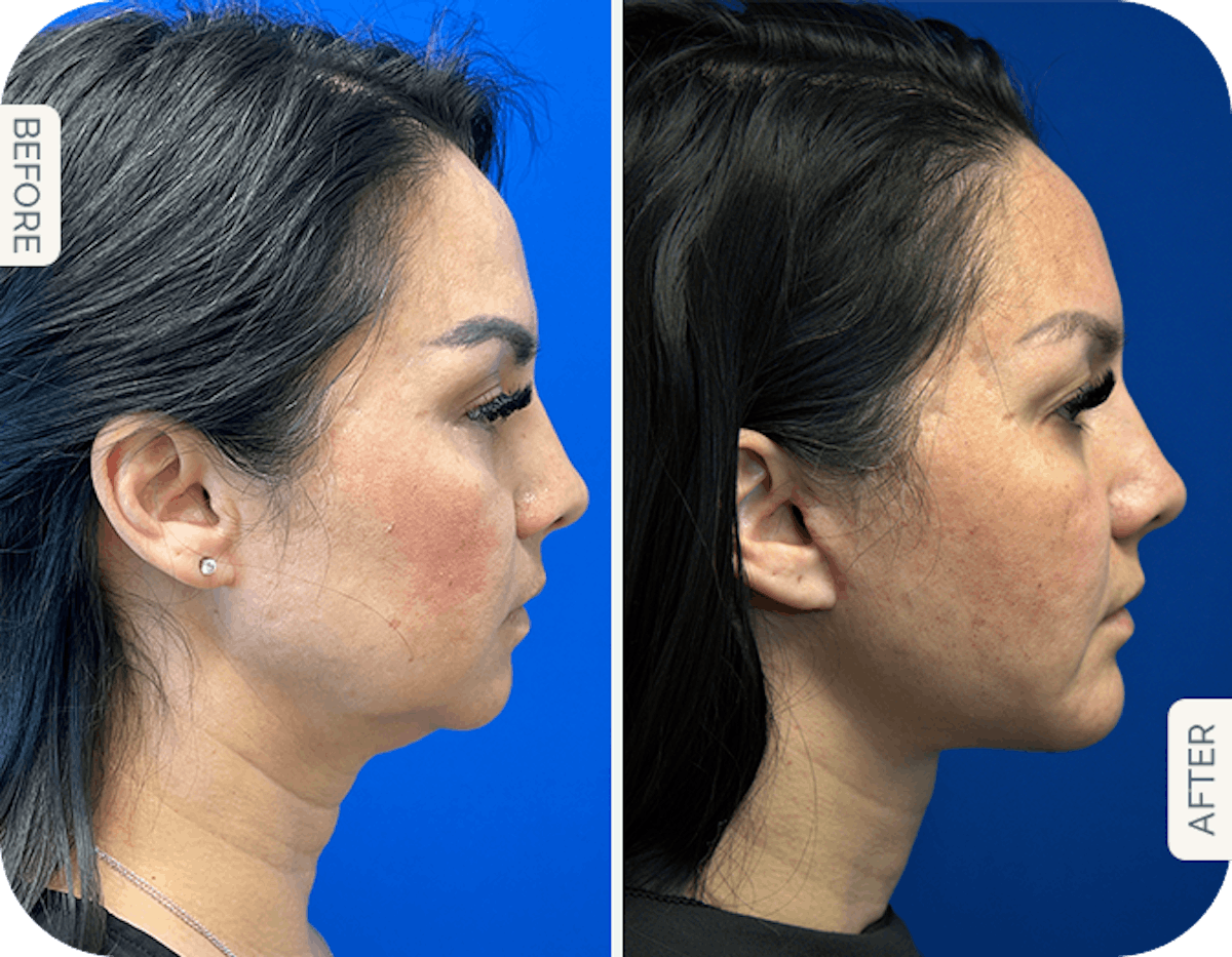 Chin Augmentation Before & After Gallery - Patient 426030 - Image 1
