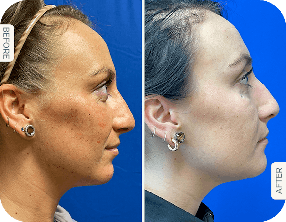 Miami Chin Augmentation Before & After Gallery - Patient 252762 - Image 1 - The Chopra Plastic Surgery Center