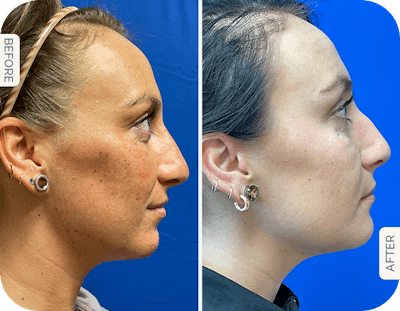 Miami Chin Augmentation Before & After Gallery - Patient 252762 - Image 1 - The Chopra Plastic Surgery Center