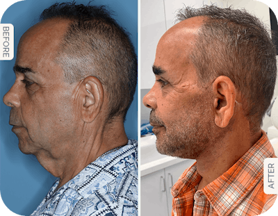 Miami Facelift/Neck Lift Before & After Gallery - Patient 189945 - Image 1 - The Chopra Plastic Surgery Center