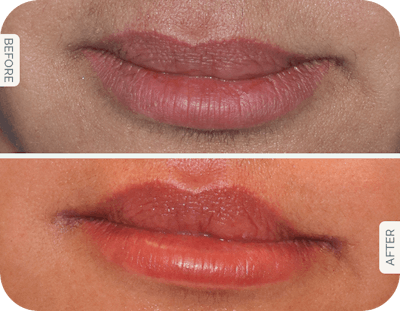 Miami Lip Lift Before & After Gallery - Patient 646615 - Image 1 - The Chopra Plastic Surgery Center