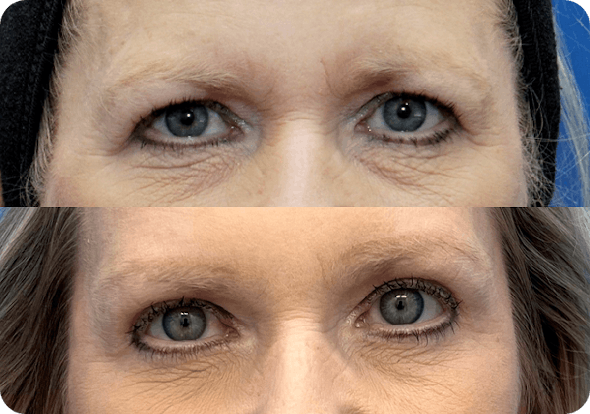 Upper Eyelid Lift Before & After Gallery - Patient 331159 - Image 1