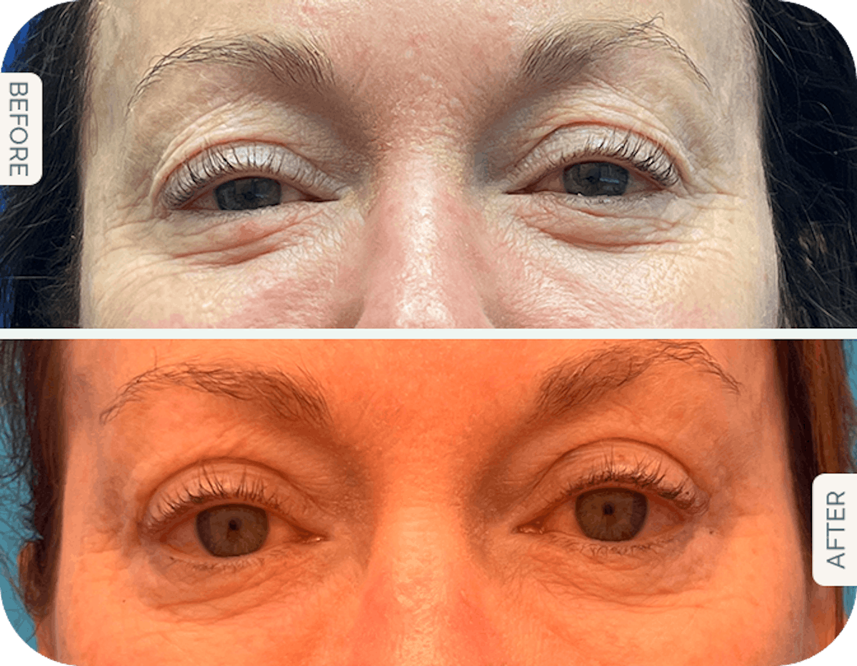Upper Eyelid Lift Before & After Gallery - Patient 354039 - Image 1