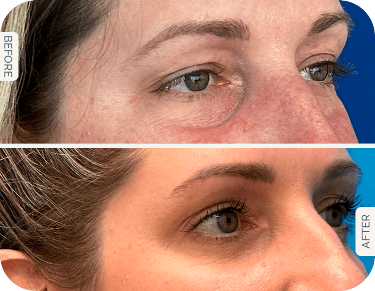 Miami Upper Eyelid Lift Before & After Gallery - Patient 201788 - Image 1 - The Chopra Plastic Surgery Center