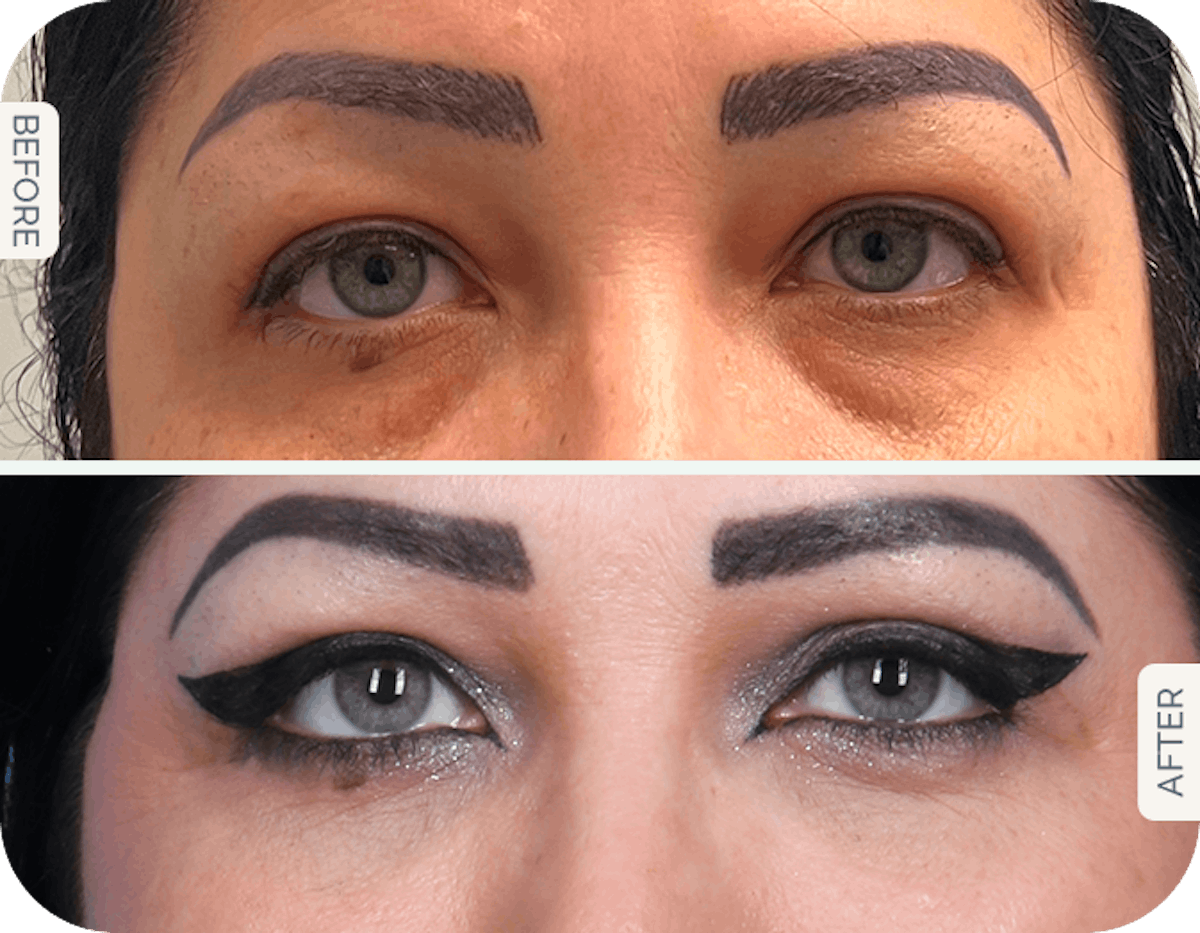 Miami Upper Eyelid Lift Before & After Gallery - Patient 125966 - Image 1 - The Chopra Plastic Surgery Center