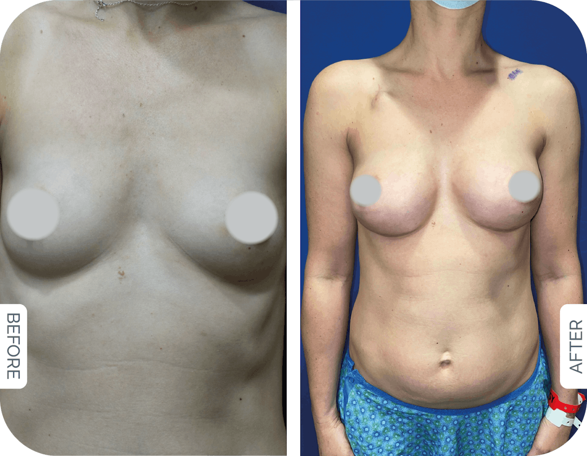 Breast Reconstruction Before & After Gallery - Patient 101384 - Image 1