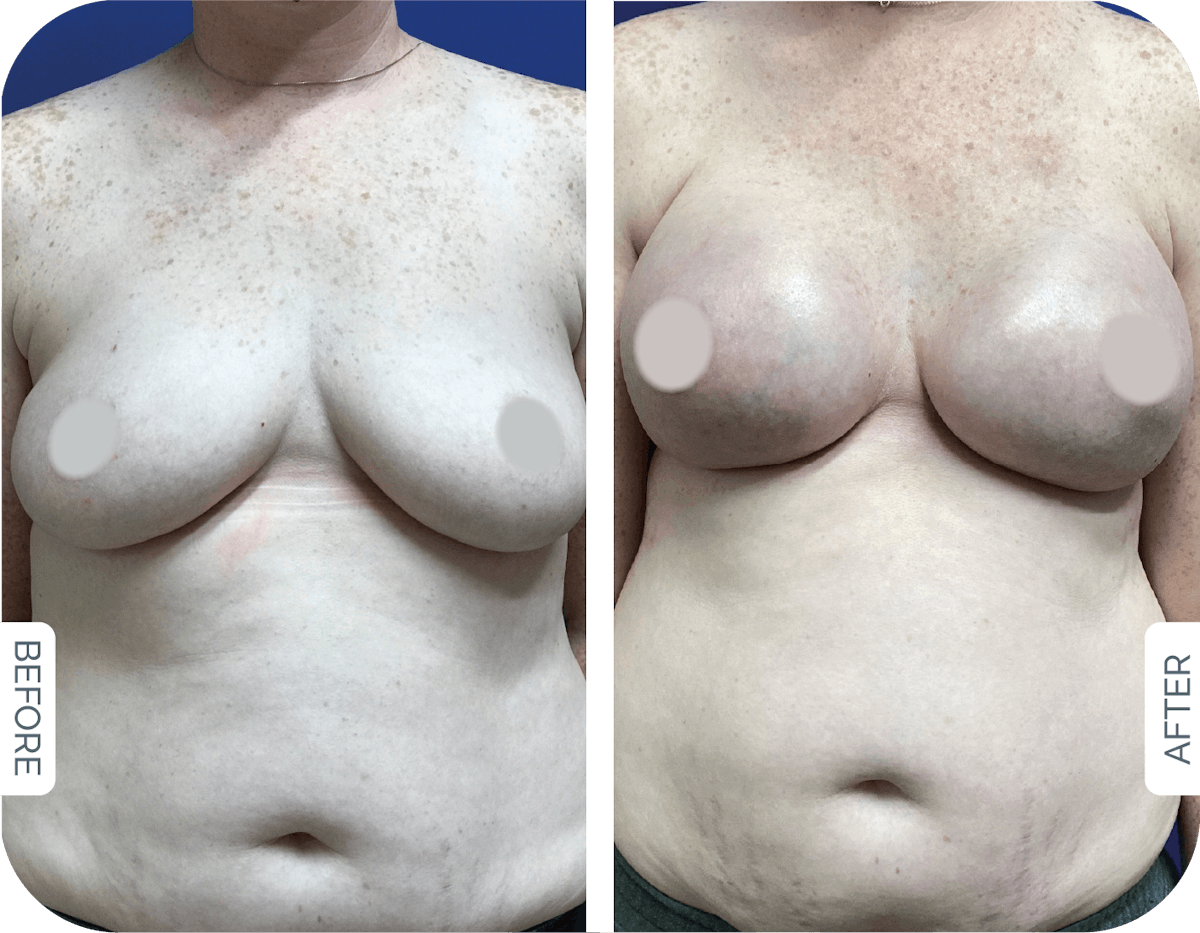 Breast Reconstruction Before & After Gallery - Patient 403853 - Image 1
