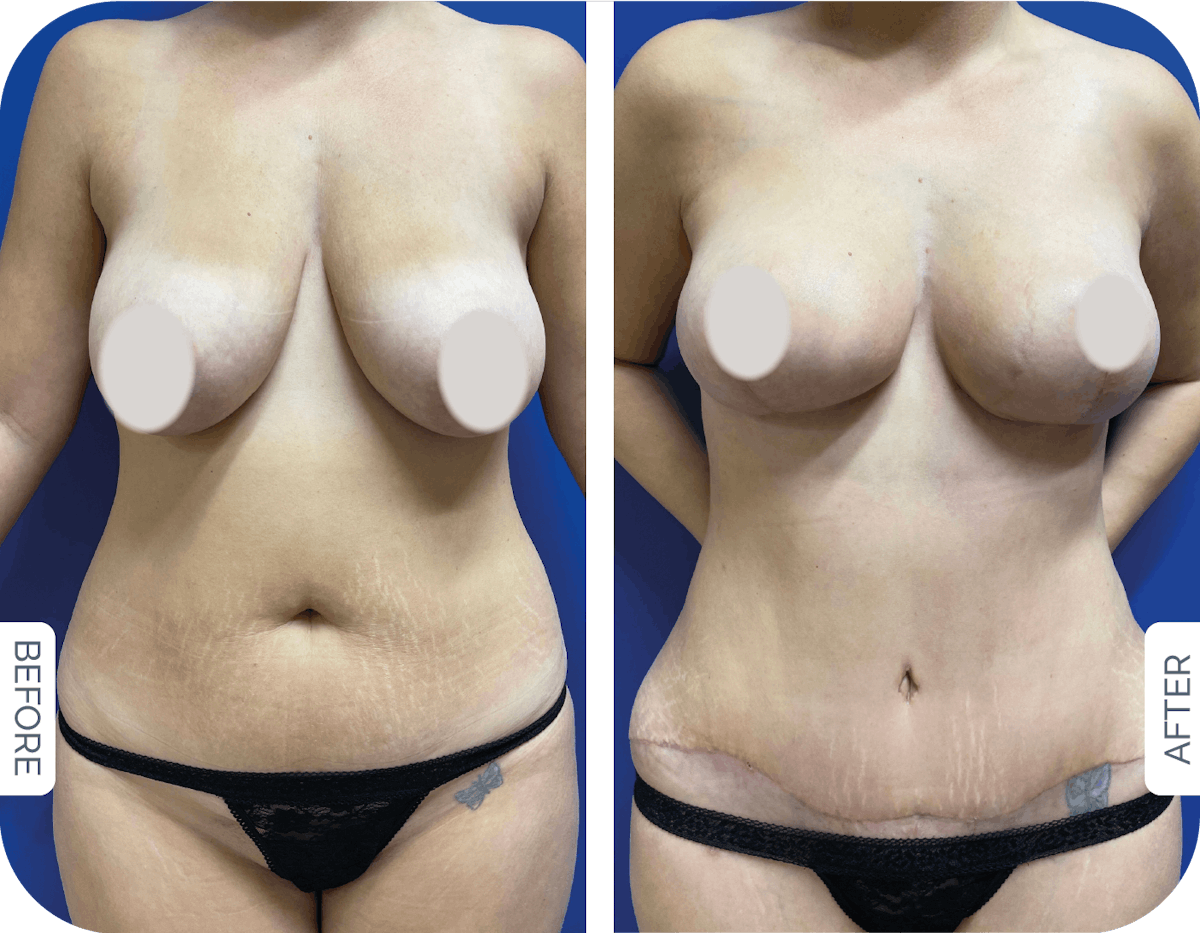 Drainless Tummy Tuck Before & After Gallery - Patient 279378 - Image 1