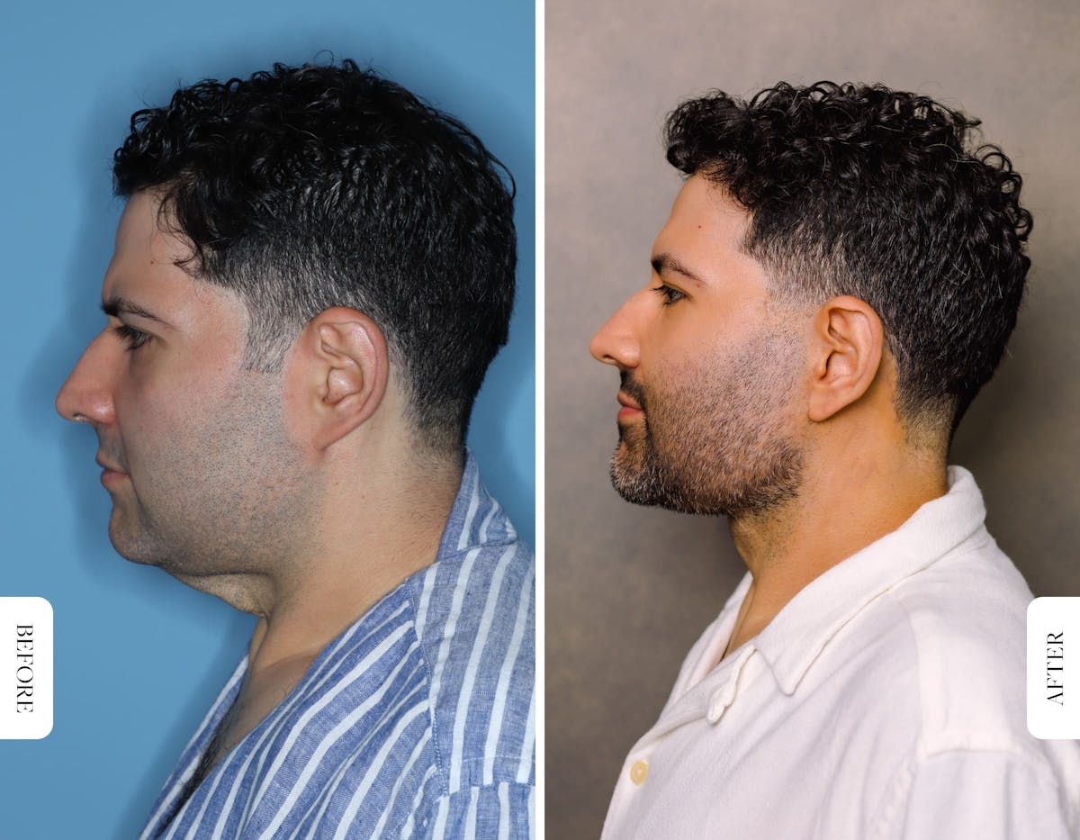 Facelift/Necklift Before & After Gallery - Patient 392804 - Image 2