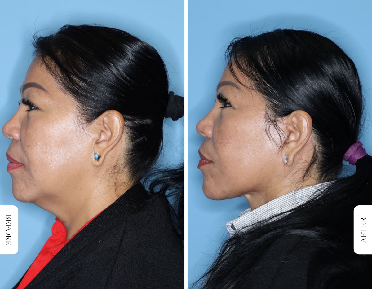 Facelift/Necklift Before & After Gallery - Patient 681237 - Image 3