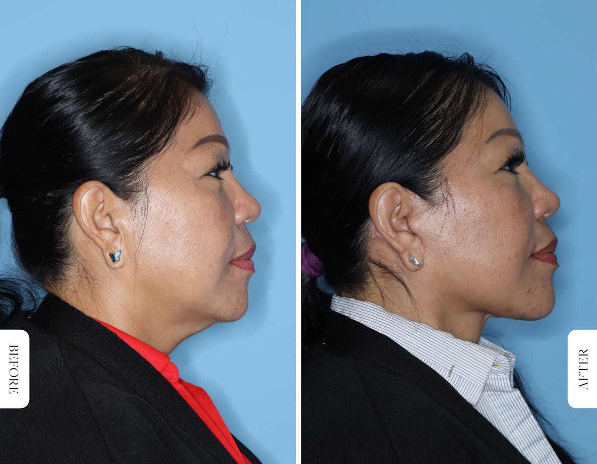 Facelift/Necklift Before & After Gallery - Patient 681237 - Image 5