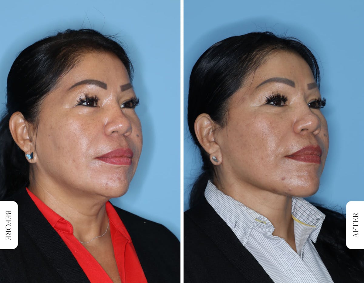 Facelift/Necklift Before & After Gallery - Patient 681237 - Image 4