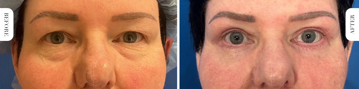 Miami Lower Eyelid Lift Before & After Gallery - Patient 562928 - Image 1 - The Chopra Plastic Surgery Center