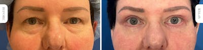 Miami Lower Eyelid Lift Before & After Gallery - Patient 562928 - Image 1 - The Chopra Plastic Surgery Center