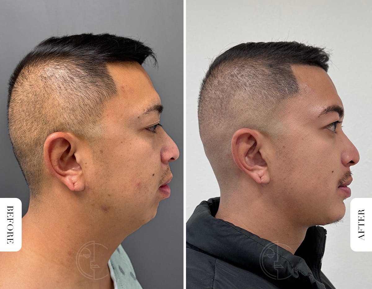 Miami Chin Augmentation Before & After Gallery - Patient 220368 - Image 2 - The Chopra Plastic Surgery Center